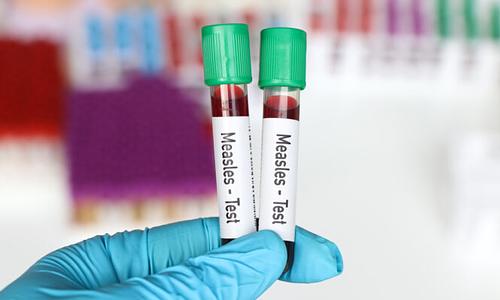 Αλarming αύξηση κρουσμάτων ιλαράς στην ΕΕ: σχεδόν 1.000 σε 4 μήνες