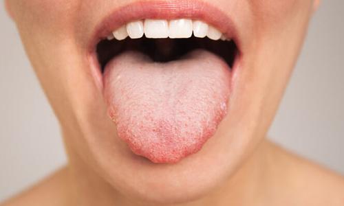 Επαναστατική προσθετική γλώσσα επαναφέρει την ομιλία σε πρώην ασθενή με καρκίνο
